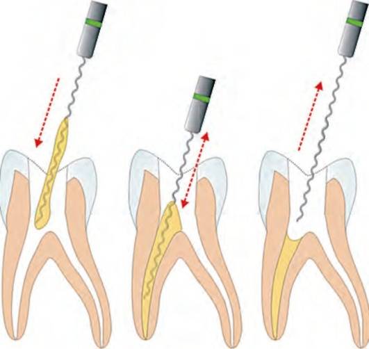 Пасты пломбирования каналов зубов